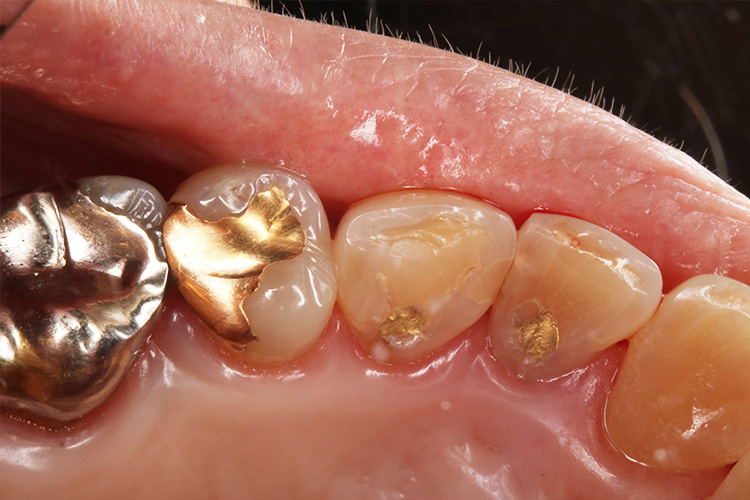 奥歯の金歯治療（金修復）のご相談は、銀座の「横田歯科診療所」へ
